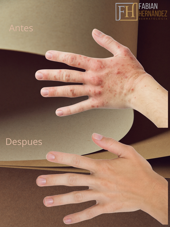 Tratamiento de la dermatitis de contacto