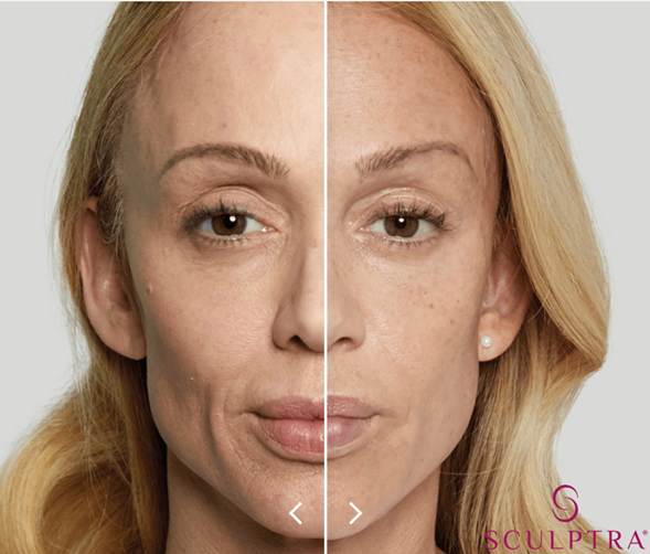 Sculptra caso 2