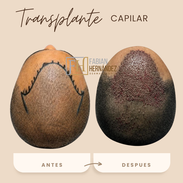 Técnica FUE de trasplante capilar