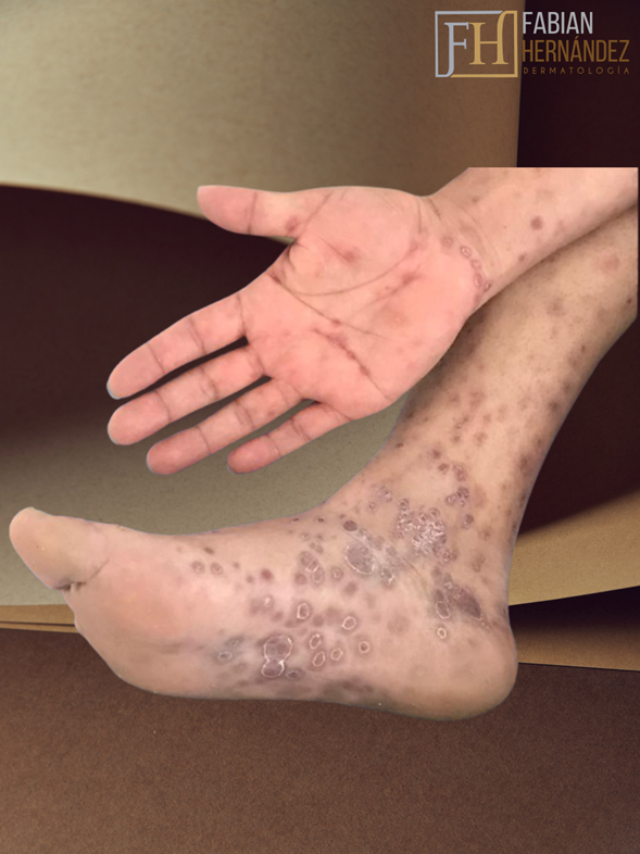 Tratamiento Dermopatías VIH