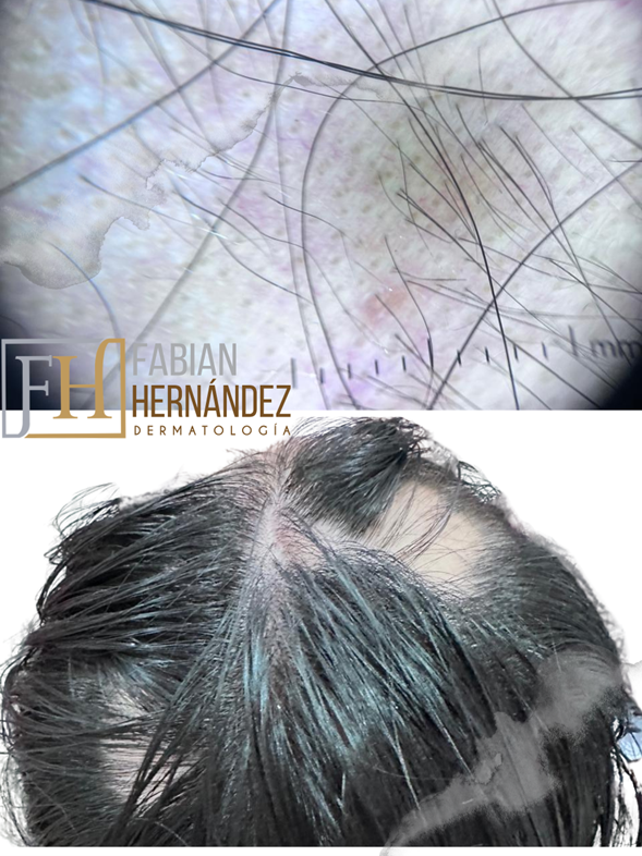 Tratamiento de la alopecia areata
