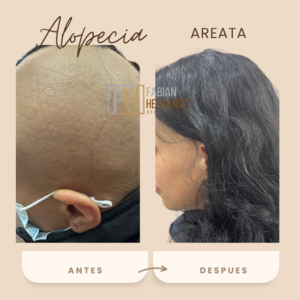 Tratamiento de la alopecia areata