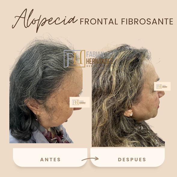 Tratamiento de la alopecia frontal fibrosante