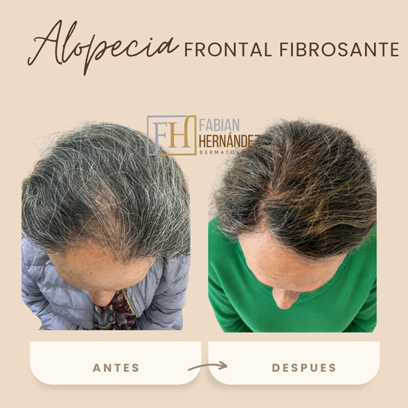 Tratamiento de la alopecia frontal fibrosante