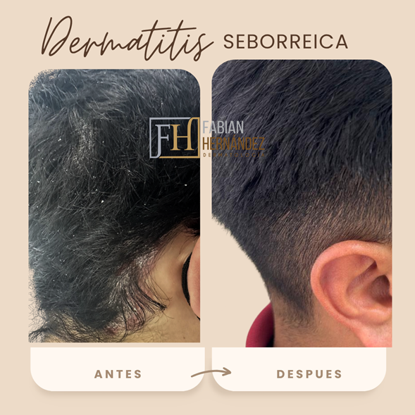 Tratamiento de la dermatitis seborreica