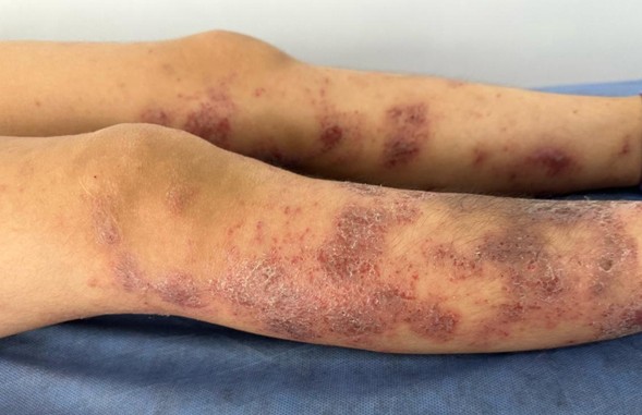 Tratamiento de la dermatitis atópica