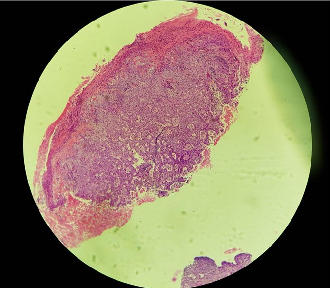 Detección y diagnóstico del cáncer de piel