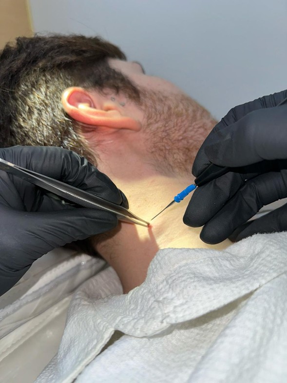 Aplicación de electrocauterización