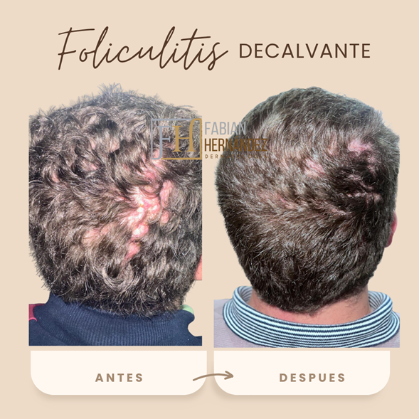Tratamiento de la foliculitis decalvante