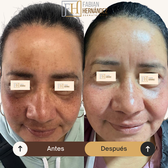 Hiperpigmentación post-inflamatoria 1