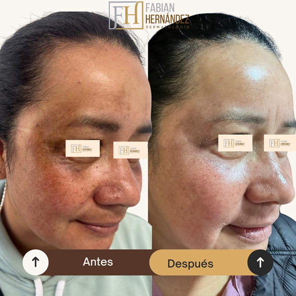 Hiperpigmentación post-inflamatoria 2