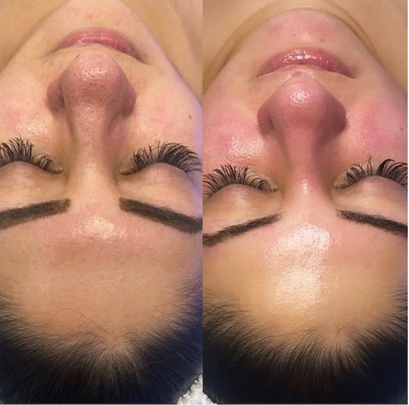 Procedimiento HydraBeauty