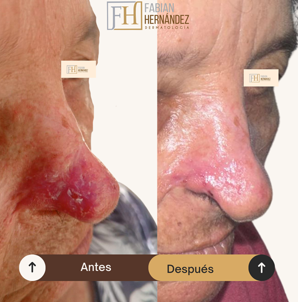 Inmunoterapia tópica