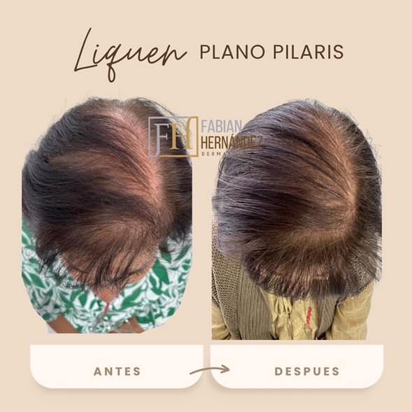 Tratamiento del liquen plano pilaris