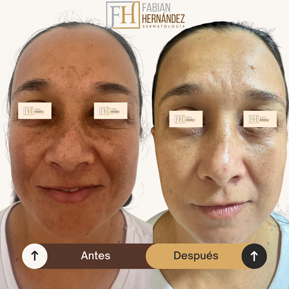 Melasma caso 1