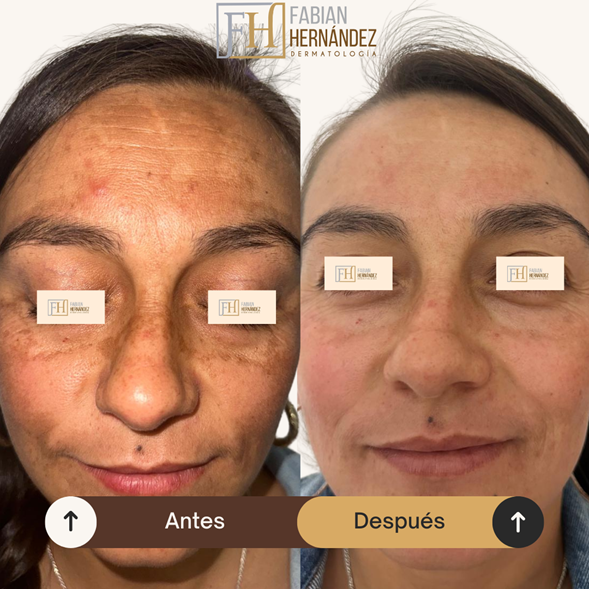 Melasma caso 2