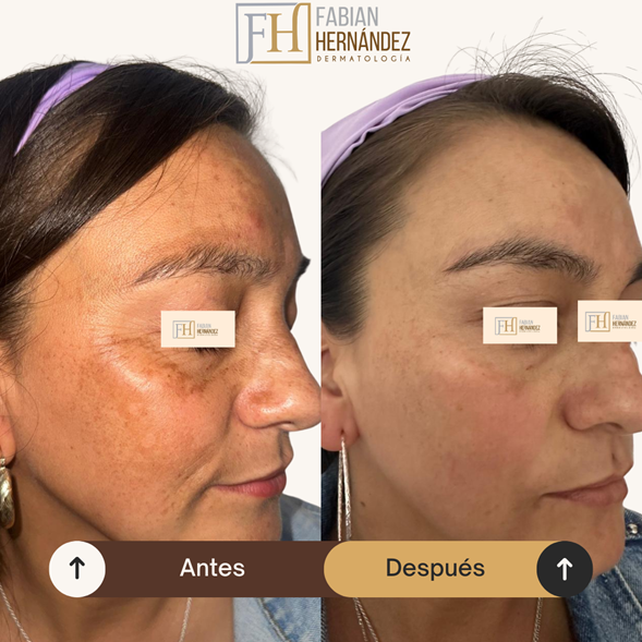 Melasma caso 3