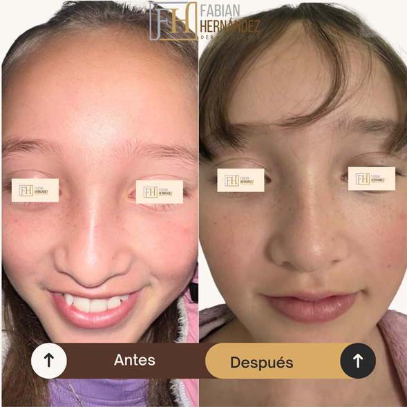 Pecas o efélides