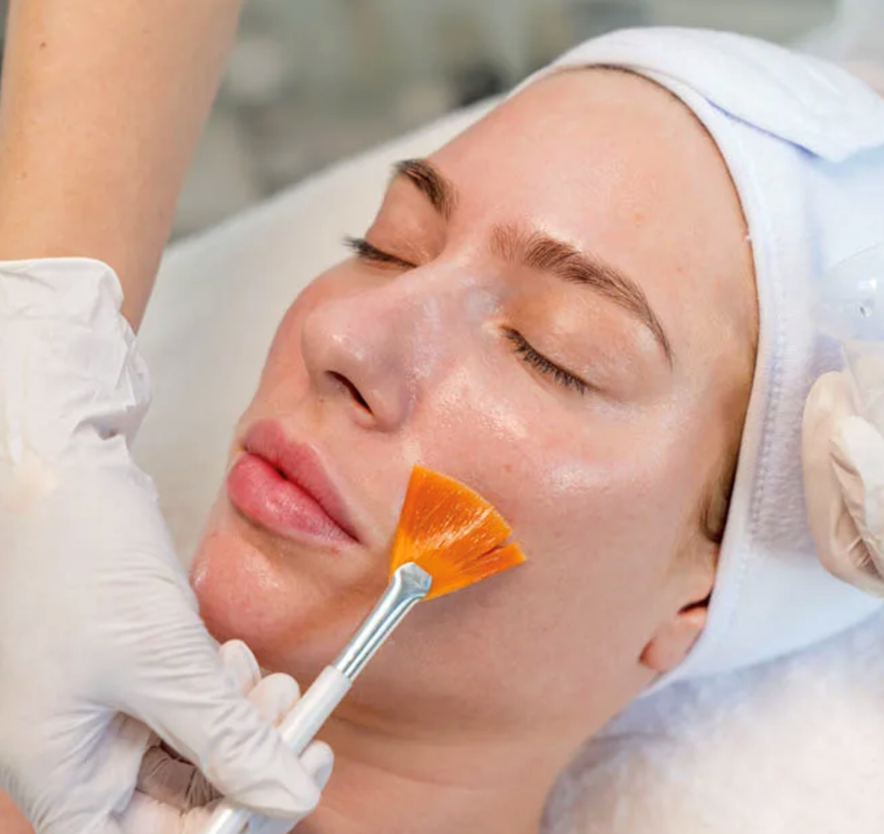 Zonas de aplicación del peeling químico