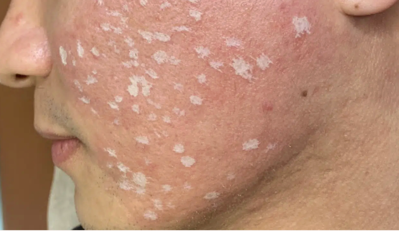 Peeling químico medio