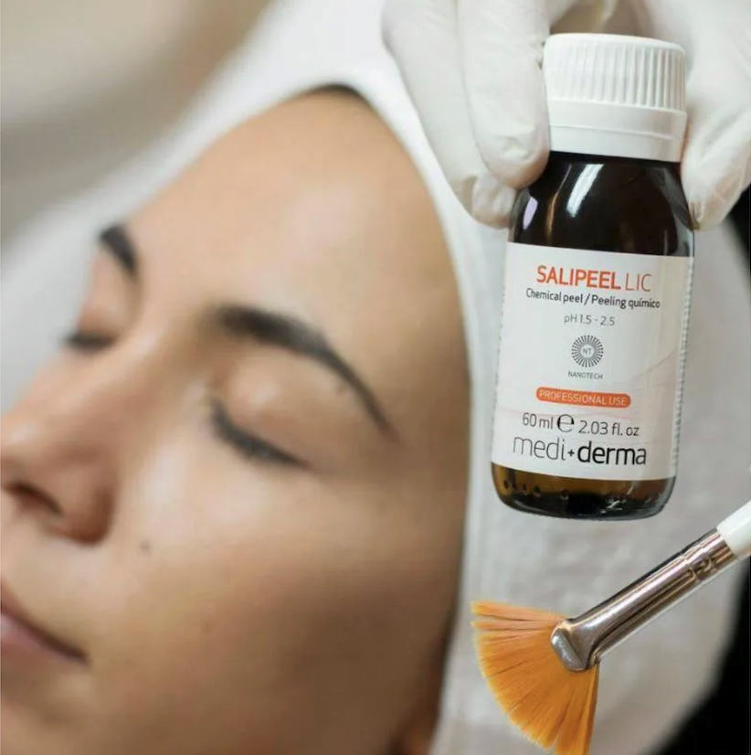 Peeling químico superficial