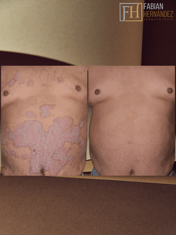 Tratamiento de la psoriasis